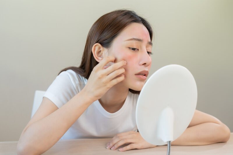Skin Irritation and Redness